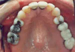 Dallas Tooth Colored Fillings